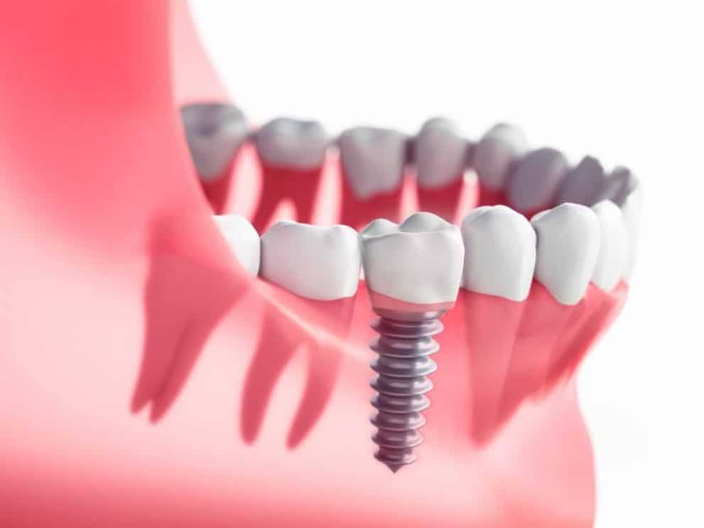 Illustration of single tooth dental implants in Benbrook