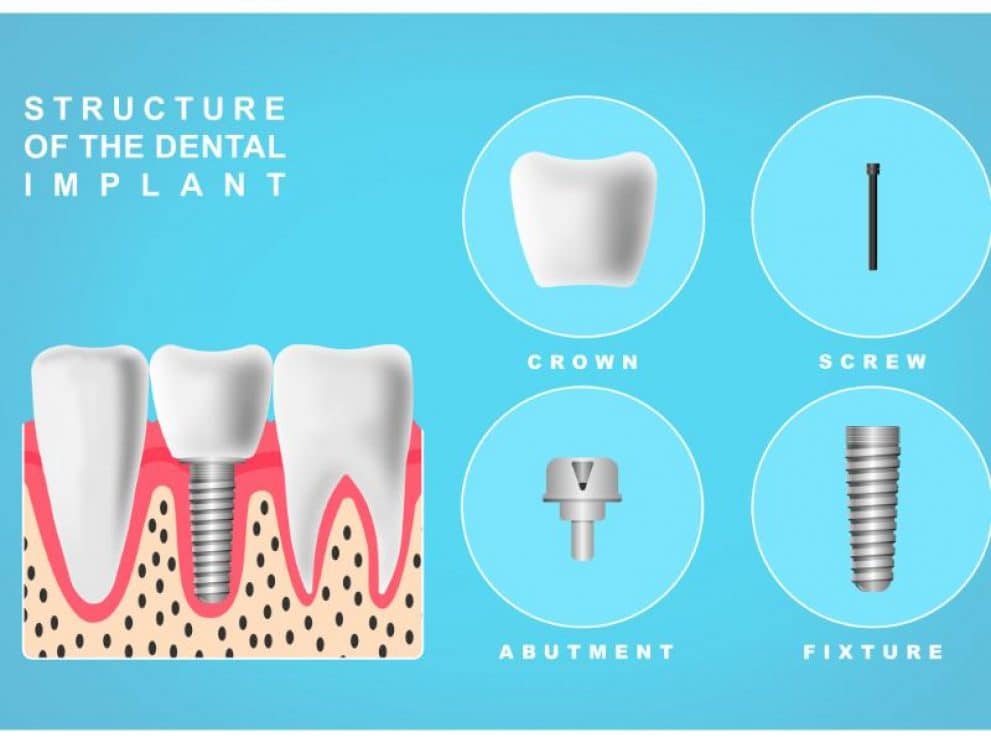Example of the structure of a single-tooth dental implant